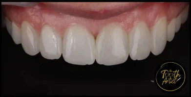 a15 Smile Gallery