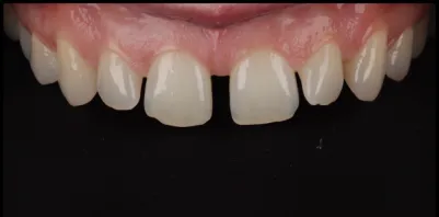 b15 Smile Gallery