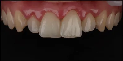b6 Smile Gallery
