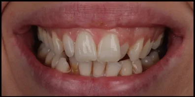 Layer 1 6 Smile Gallery